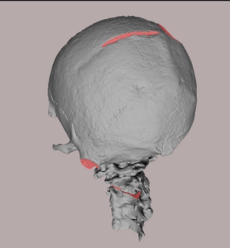 ricostruzione cranio 3d